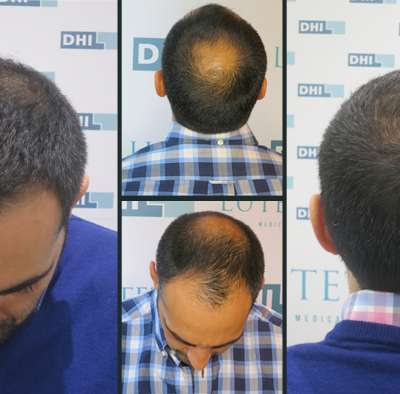 Hair transplantation