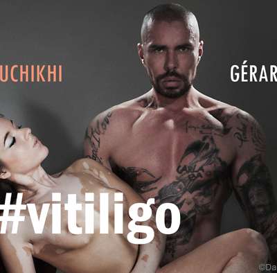 Nadia Bouchikhi, young hairdresser, has Vitiligo, so what ?