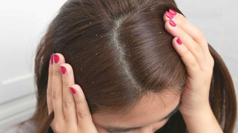 Comment en finir avec les pellicules ?