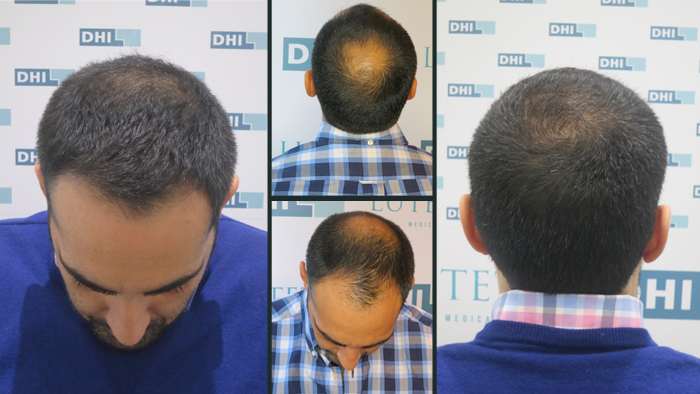 Hair transplantation