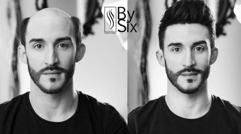 Complément capillaire homme : La solution 2016 pour la calvitie