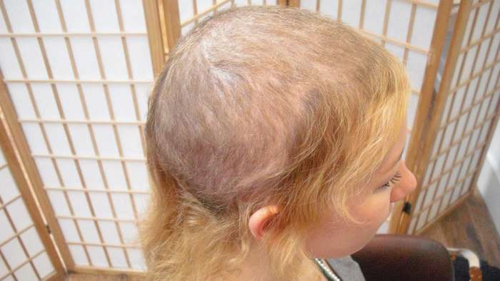 Tearing one’s hair out: French expression and psychological disorder