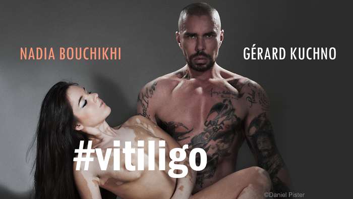 Nadia Bouchikhi, young hairdresser, has Vitiligo, so what ?